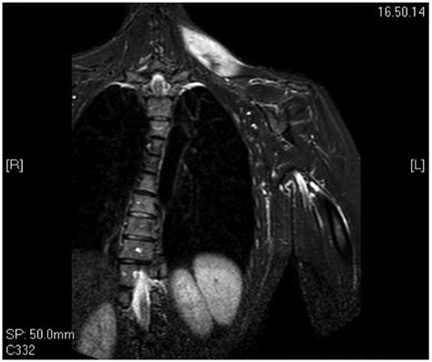 trapezius muscle tear test|trapezius muscle strain mri.